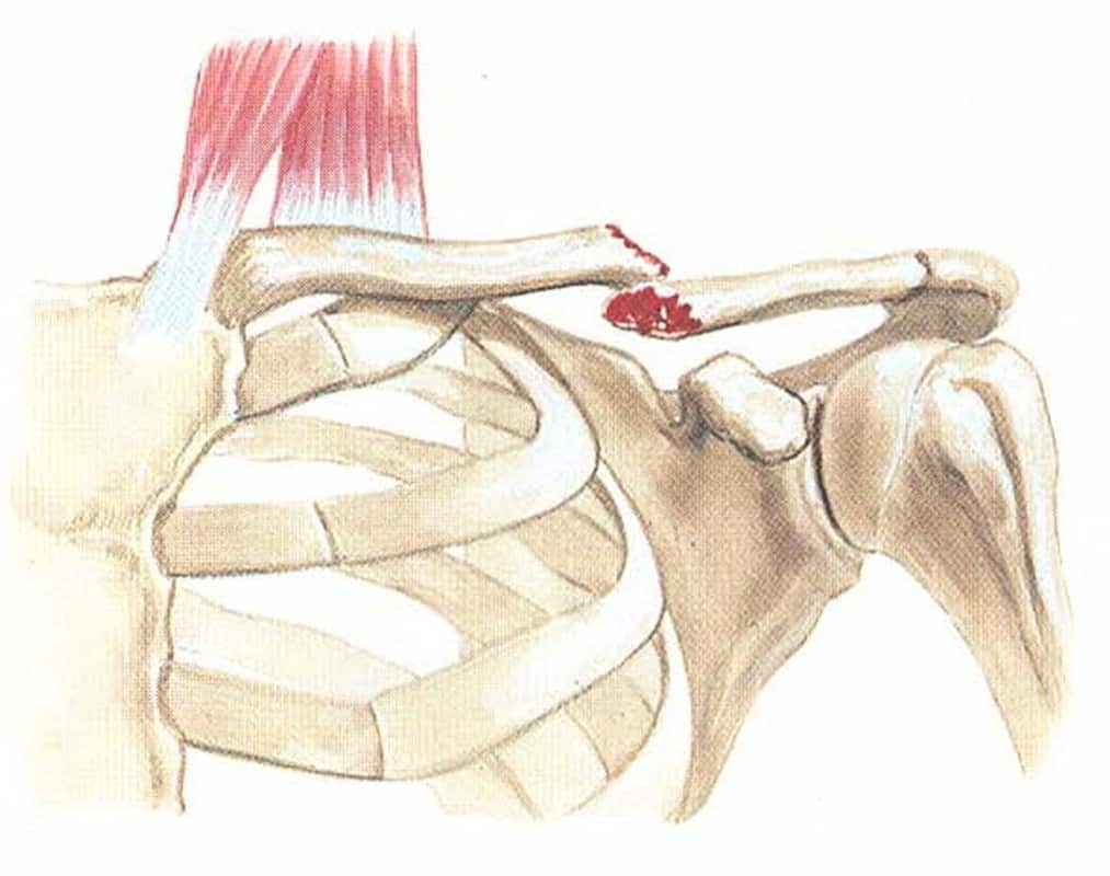 Реабилитация после перелома плечевой кости