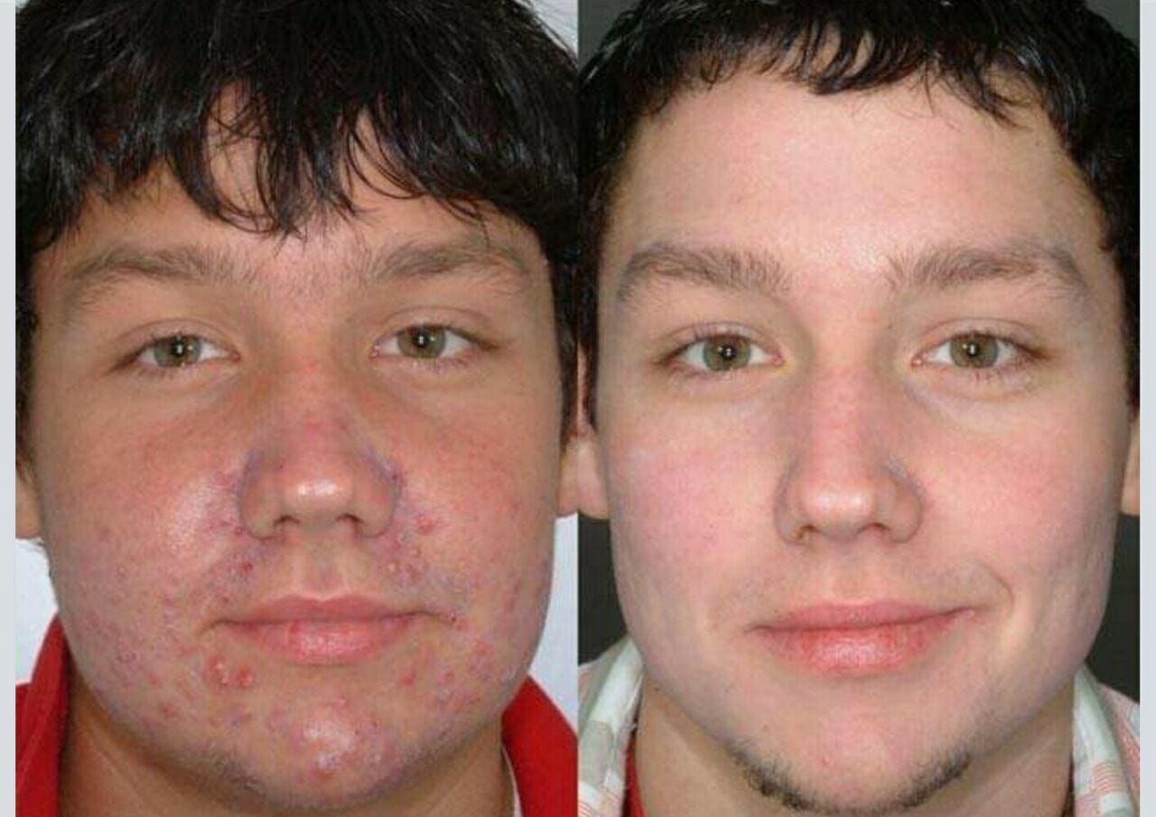 Чистка лица фото до и после