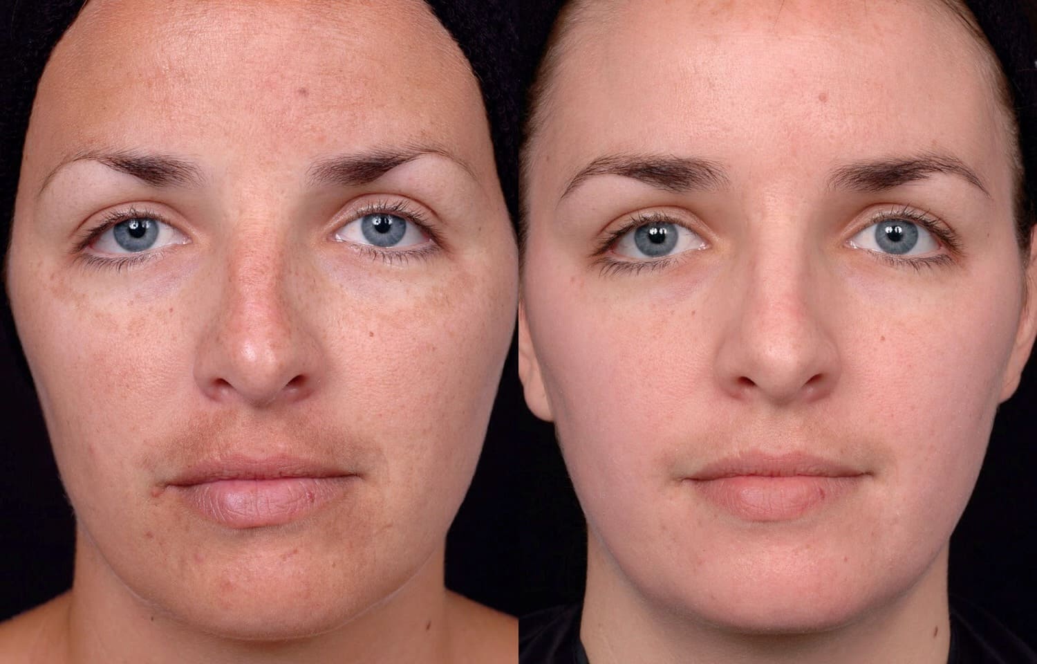 Фото до и после аппаратной косметологии