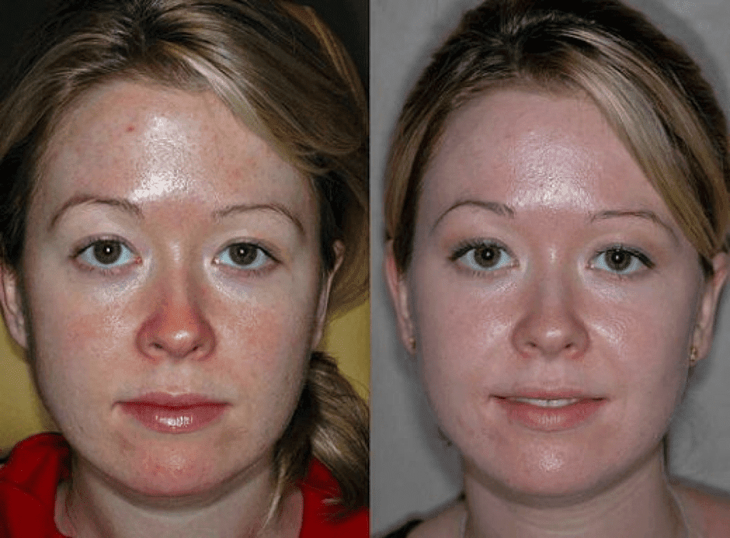 Фото после чистки лица до и после фото
