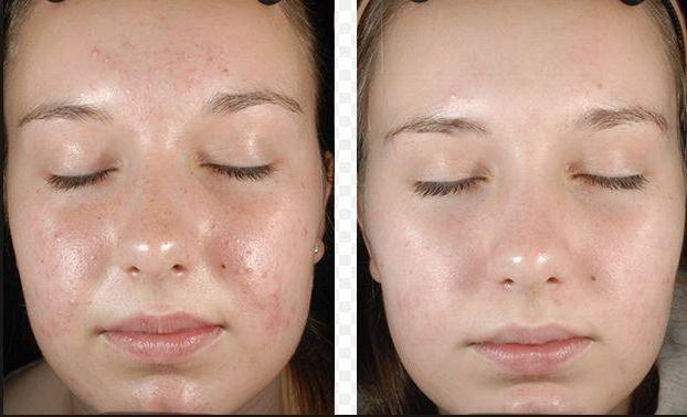 Пилинг кожи лица: для чего он нужен – Клиника 